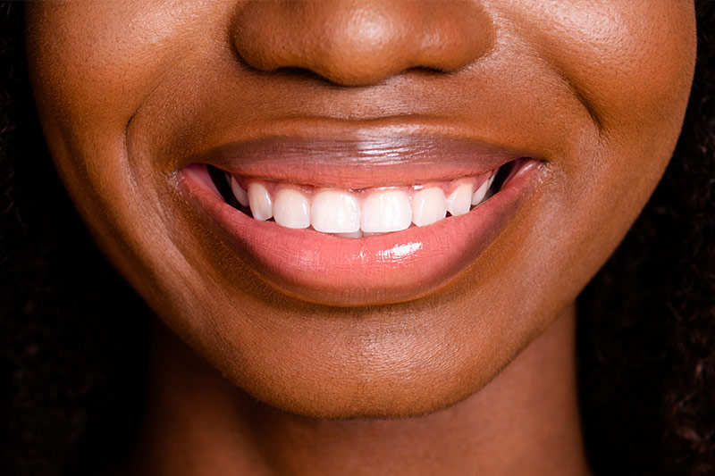 Invisalign in Huntington Beach